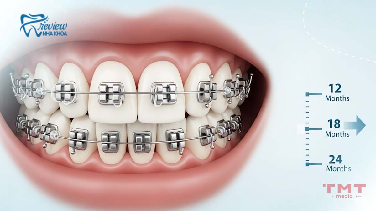 Niềng răng mắc cài kim loại mất bao lâu?