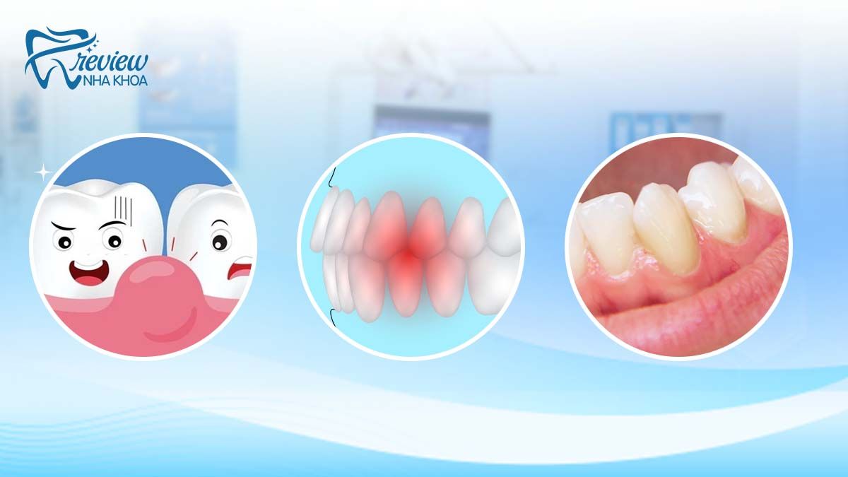 Thiếu mầm răng vĩnh viễn có ảnh hưởng gì không?