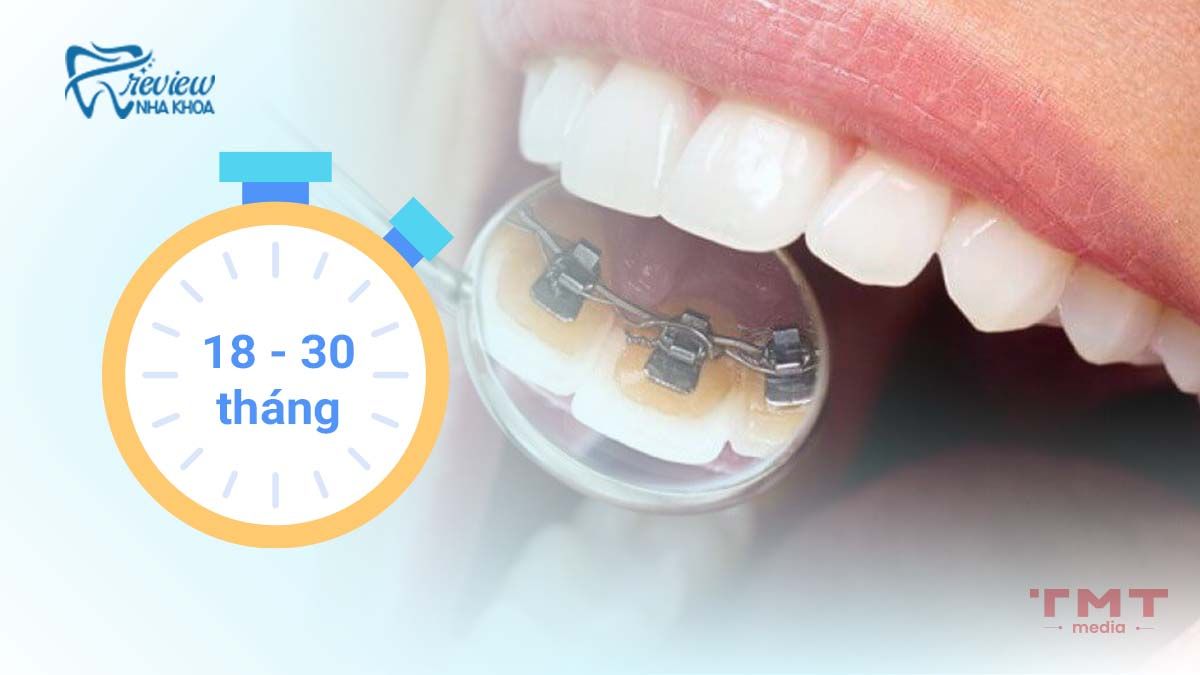 Niềng răng mặt trong mất bao lâu?