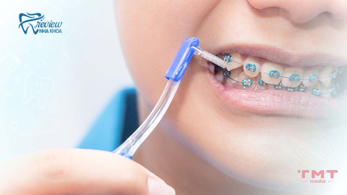 Tháo vít niềng răng có đau không? Khác gì so với tháo mắc cài