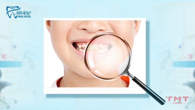 Răng nhiễm Fluor là gì
