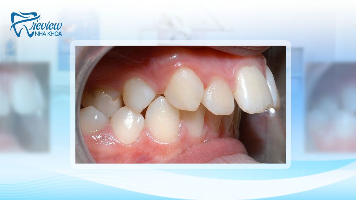 Tìm hiểu răng hô là gì?