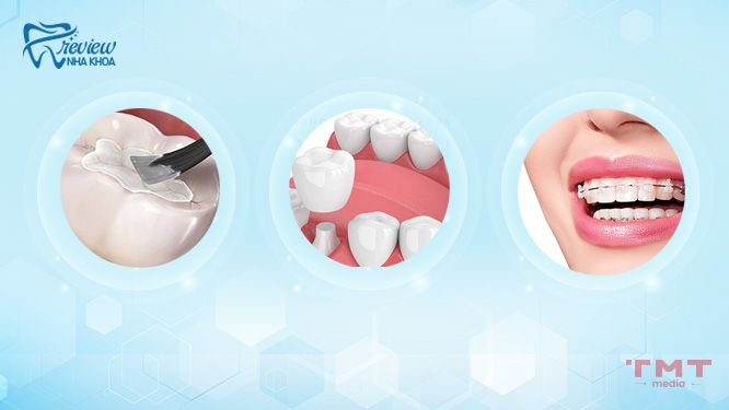 Cách khắc phục tình trạng răng thưa hiệu quả phù hợp tướng số