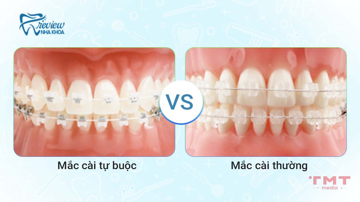 Phân biệt mắc cài tự buộc và mắc cài thường