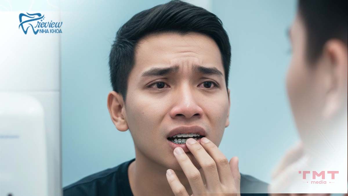 Vì sao nhiều người lo lắng trước khi tháo niềng răng?