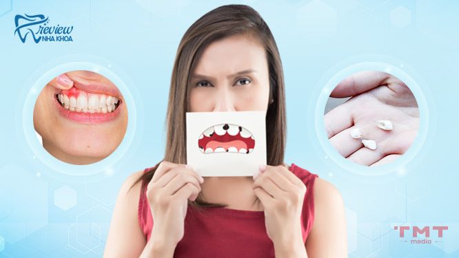 Ảnh hưởng của tình trạng răng thưa đối với sức khỏe răng miệng