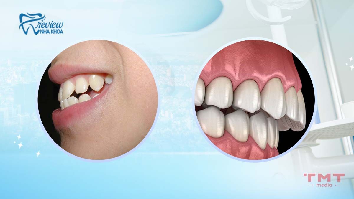 Phân biệt giữa hô hàm và hô răng