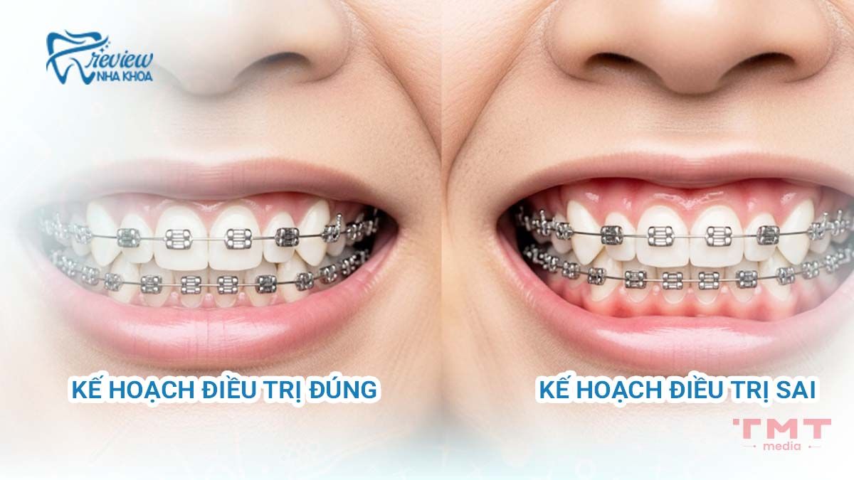 Kế hoạch điều trị sai lầm khiến niềng răng bị hở lợi