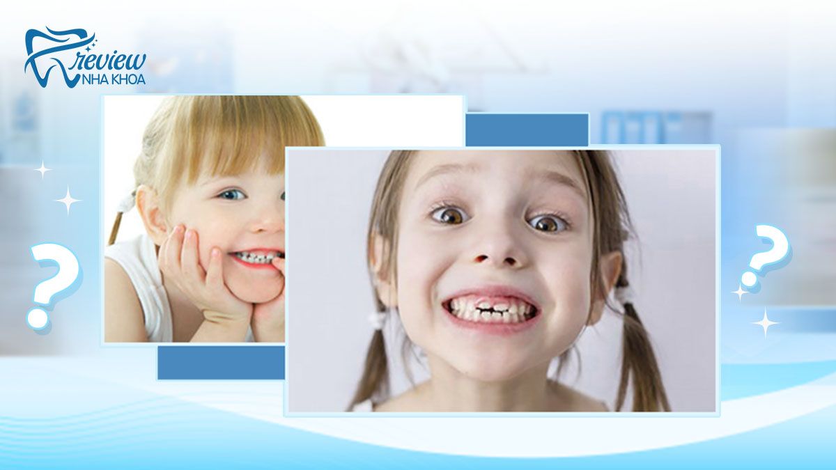 Trẻ 4 tuổi mọc răng hàm có sao không?