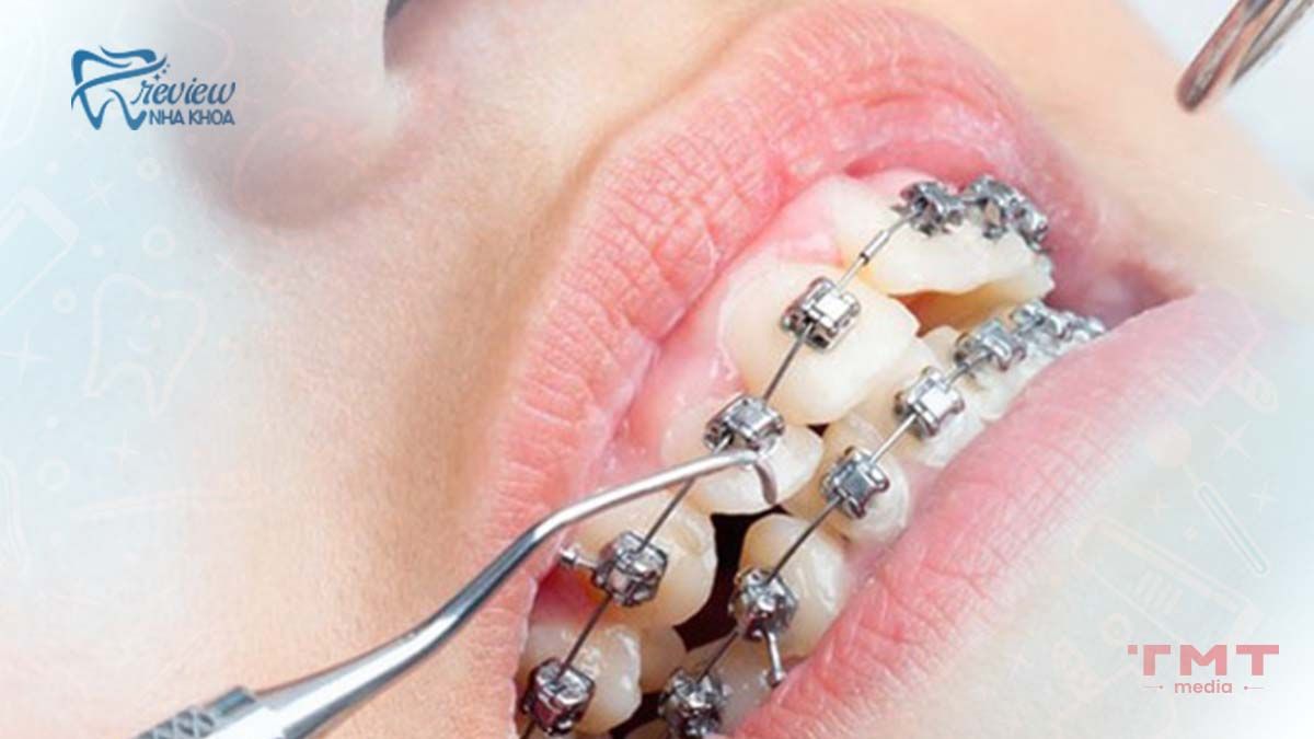 Những giai đoạn niềng răng dễ đau và khó chịu nhất