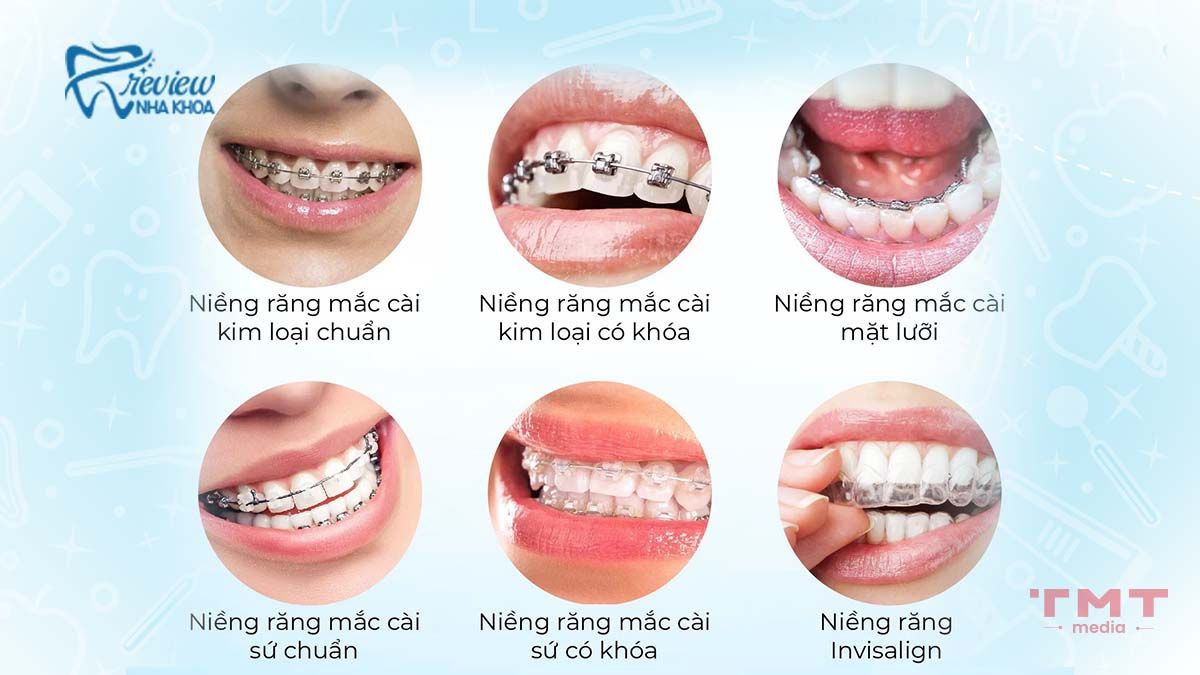 So sánh phương pháp niềng răng nào đỡ đau hơn?