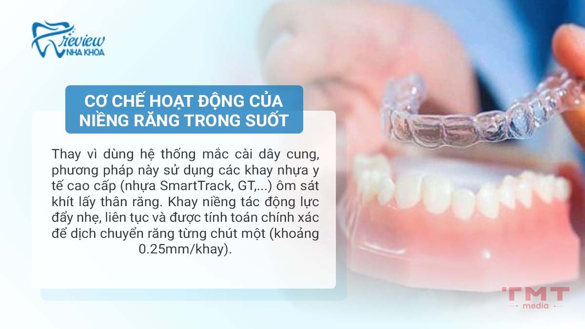 Cơ chế của niềng răng trong suốt hoạt động như thế nào?