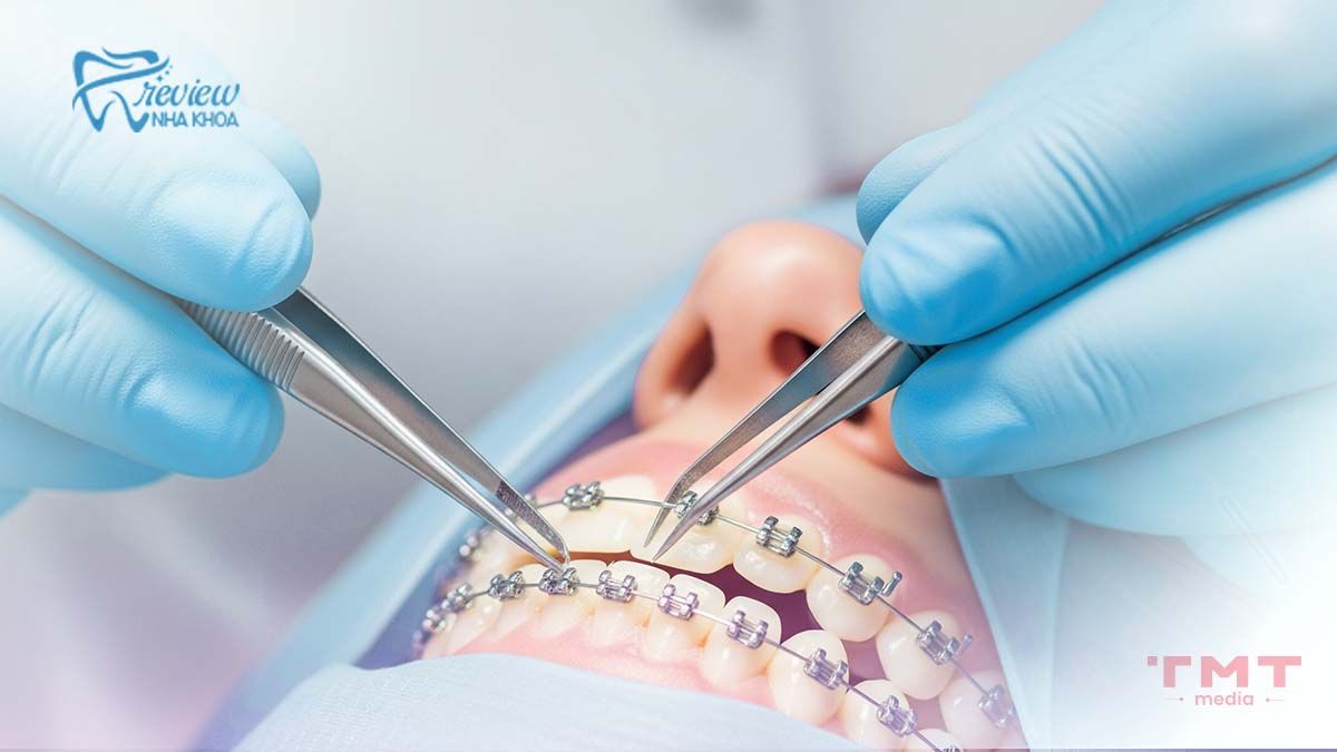 Giai đoạn 2: Chuẩn bị và đặt mắc cài/gắn khay niềng