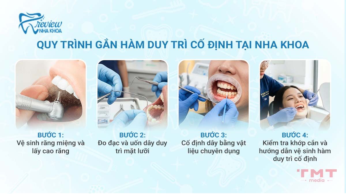 Quy trình gắn hàm duy trì mặt trong tại nha khoa