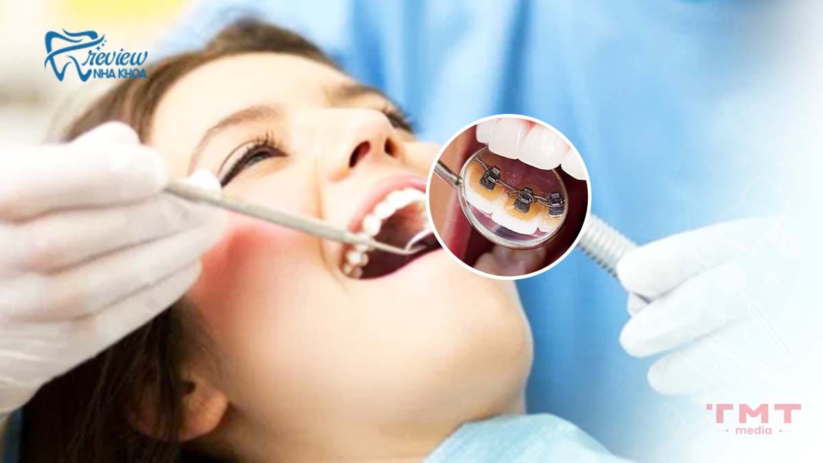  Chỉnh nha mặt trong- Bí quyết niềng răng vô hình