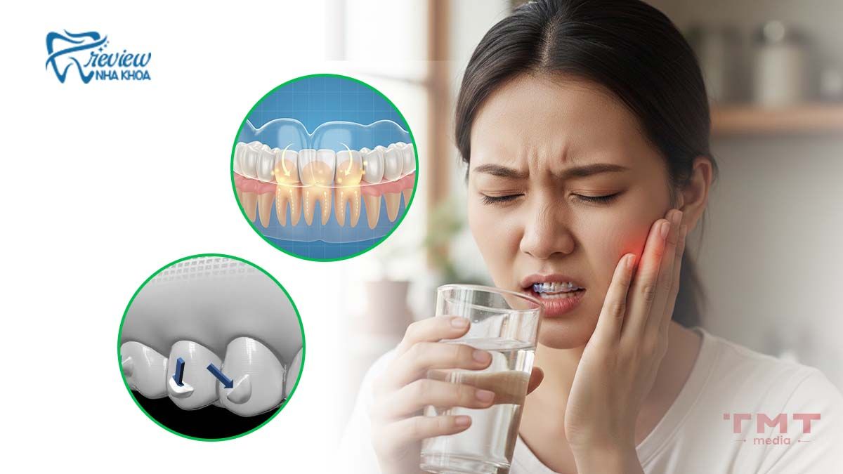 Vì sao có cảm giác đau (căng tức/ê buốt) khi niềng răng trong suốt?