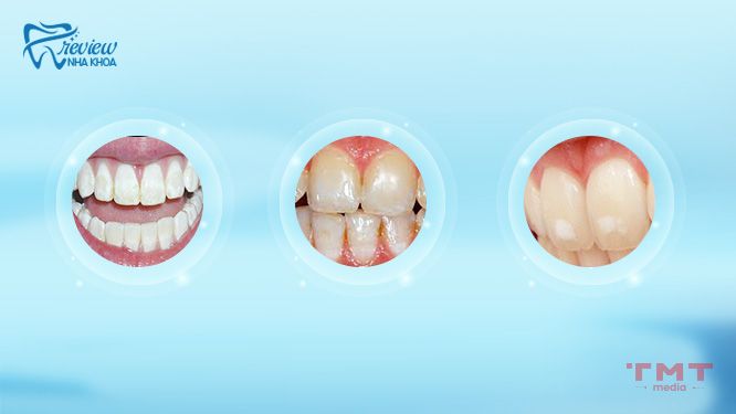 Dấu hiệu răng nhiễm Fluor là gì?