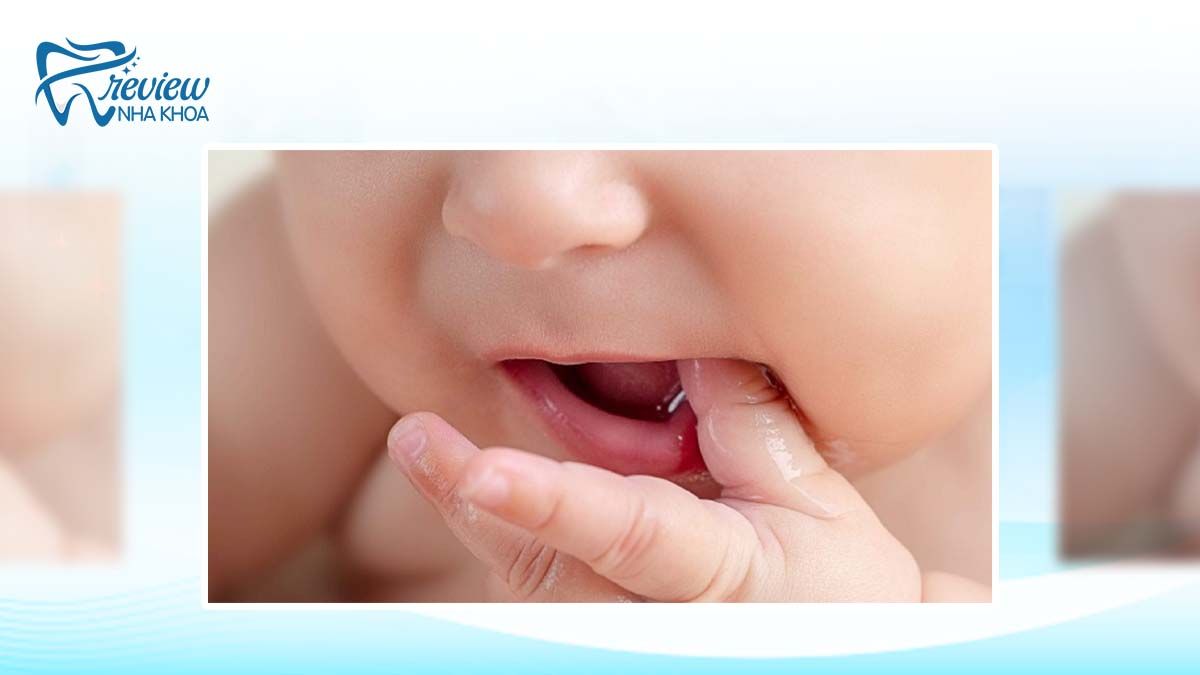 Thế nào là chậm mọc răng ở trẻ?