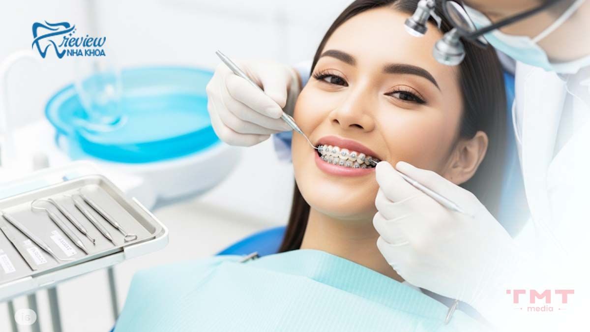 Niềng răng mắc cài sứ phương pháp thẩm mỹ hơn