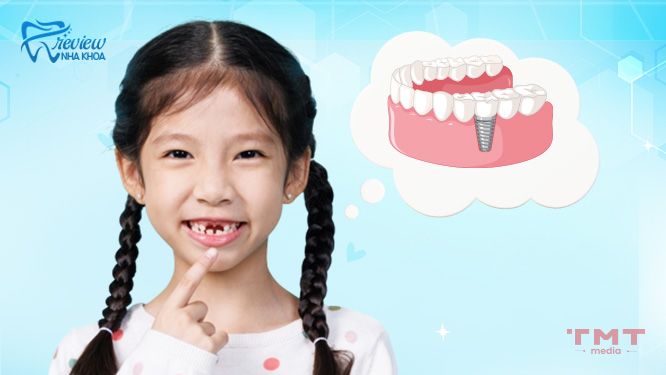 Trẻ em 14 tuổi nhổ răng hàm vĩnh viễn có trồng răng giả được không