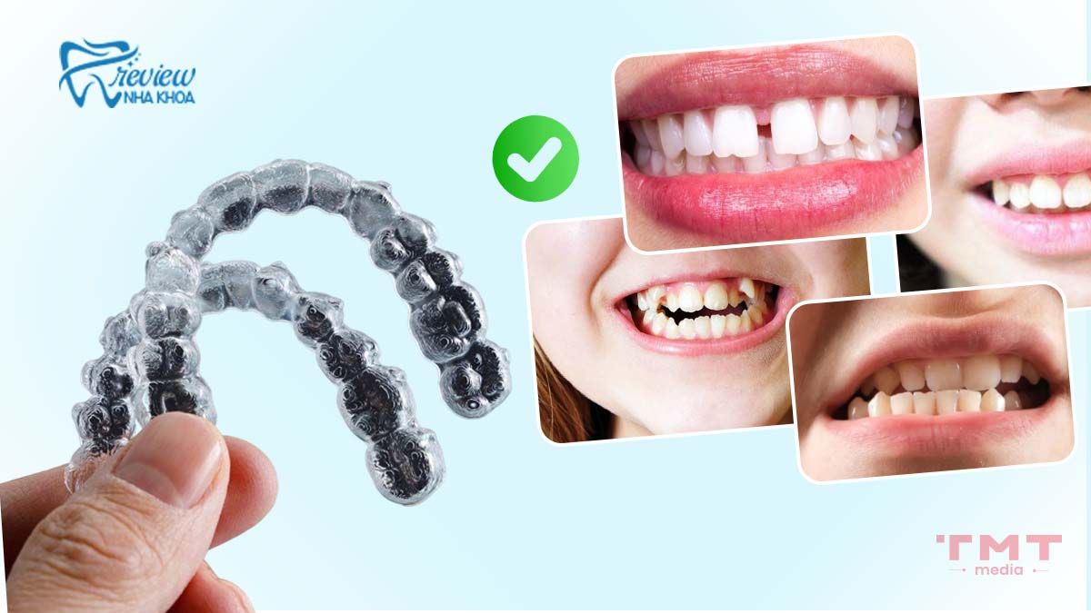 Niềng răng Invisalign phù hợp với những ai?