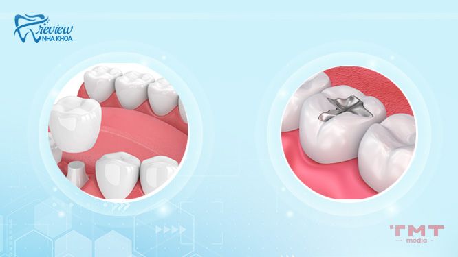 Làm sao để hạn chế hạt ổi mắc vào răng?