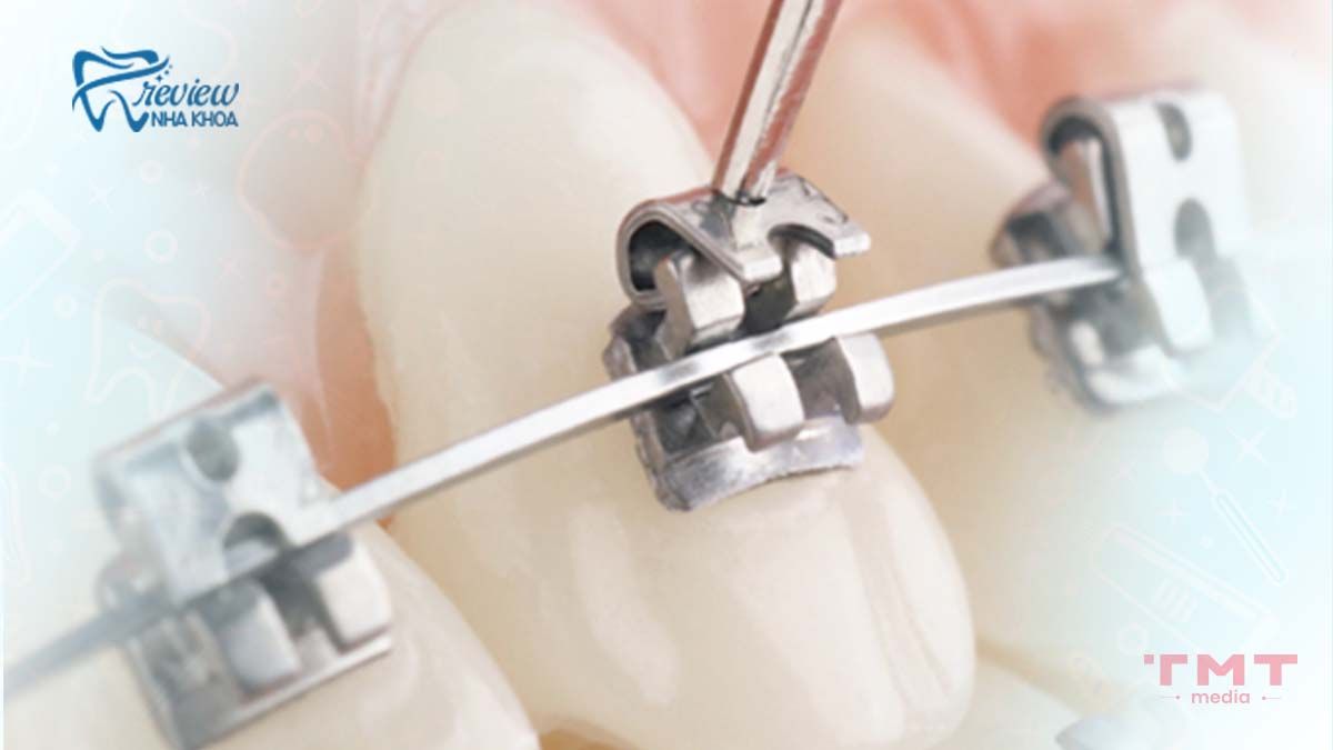 Mắc cài kim loại tự buộc là gì? Cơ chế hoạt động khác gì mắc cài thường?