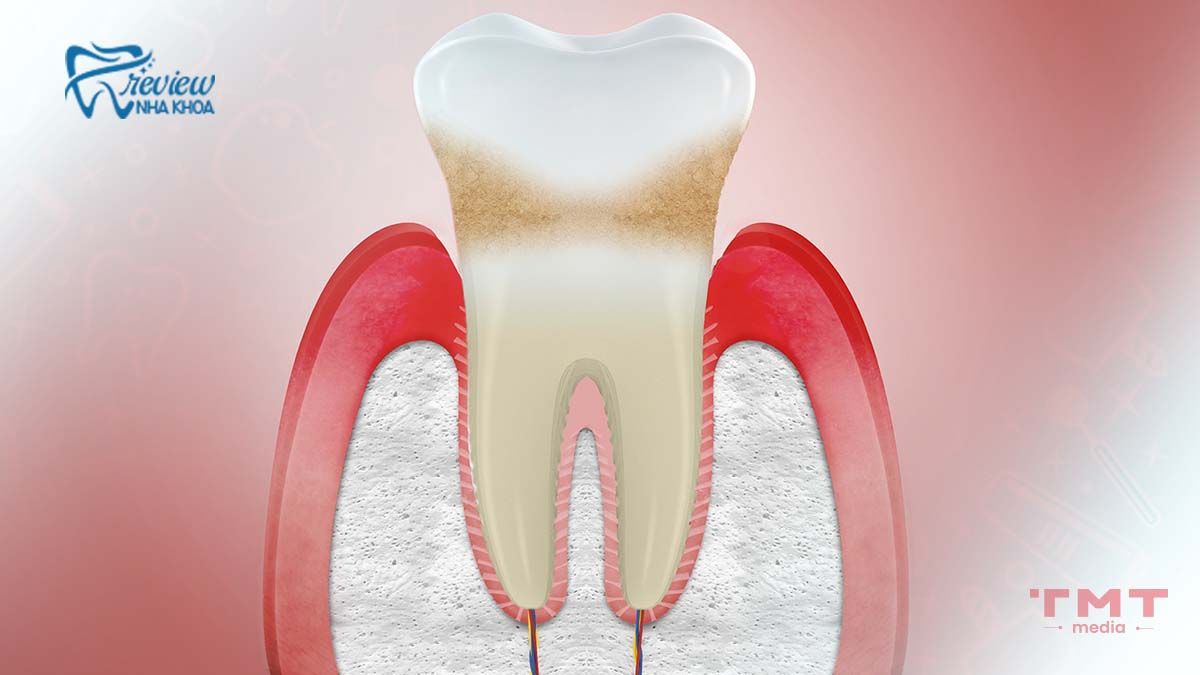 Những rủi ro tiềm ẩn, nguy cơ nếu dùng dụng cụ niềng răng không đúng 