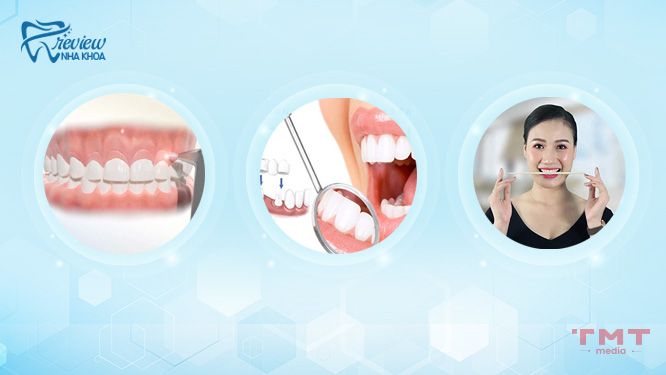 Cách chữa răng ngắn cười hở lợi ở nha khoa thay đổi tướng số