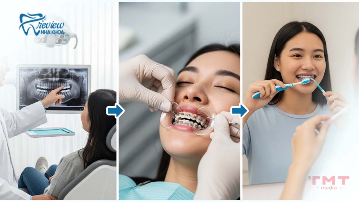 Quy trình niềng răng tổng quan và cách chăm sóc