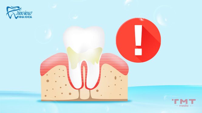 Nguyên nhân răng bị nhiễm Fluor