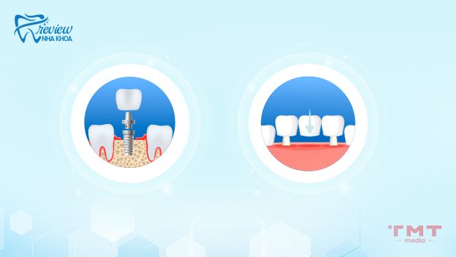 Cách khắc phục tình trạng một người chỉ có 27 cái răng