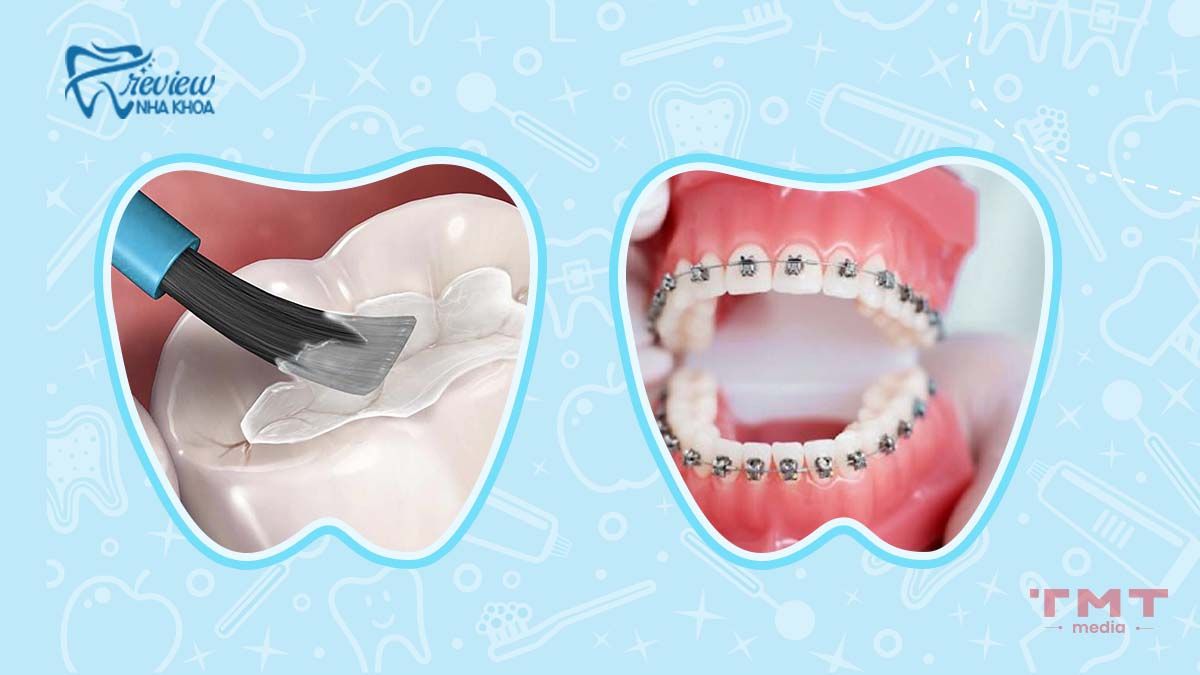 Các biện pháp xử lý từ nha khoa răng thưa nhiều
