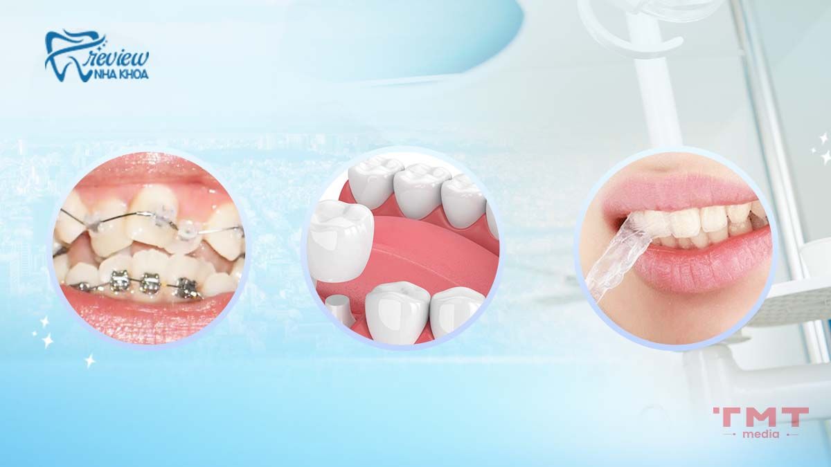 Các giải pháp điều trị chỉnh răng lệ lạch