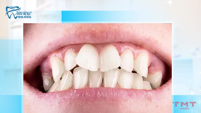 Răng quặp là răng như thế nào?