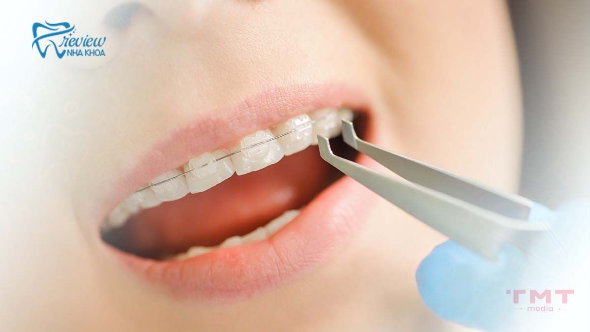 Niềng răng mắc cài sứ tự buộc là gì?