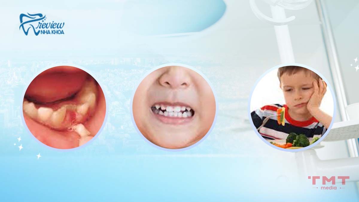 Vấn đề sức khỏe răng miệng thường kèm theo với hiện tượng mơ rụng răng
