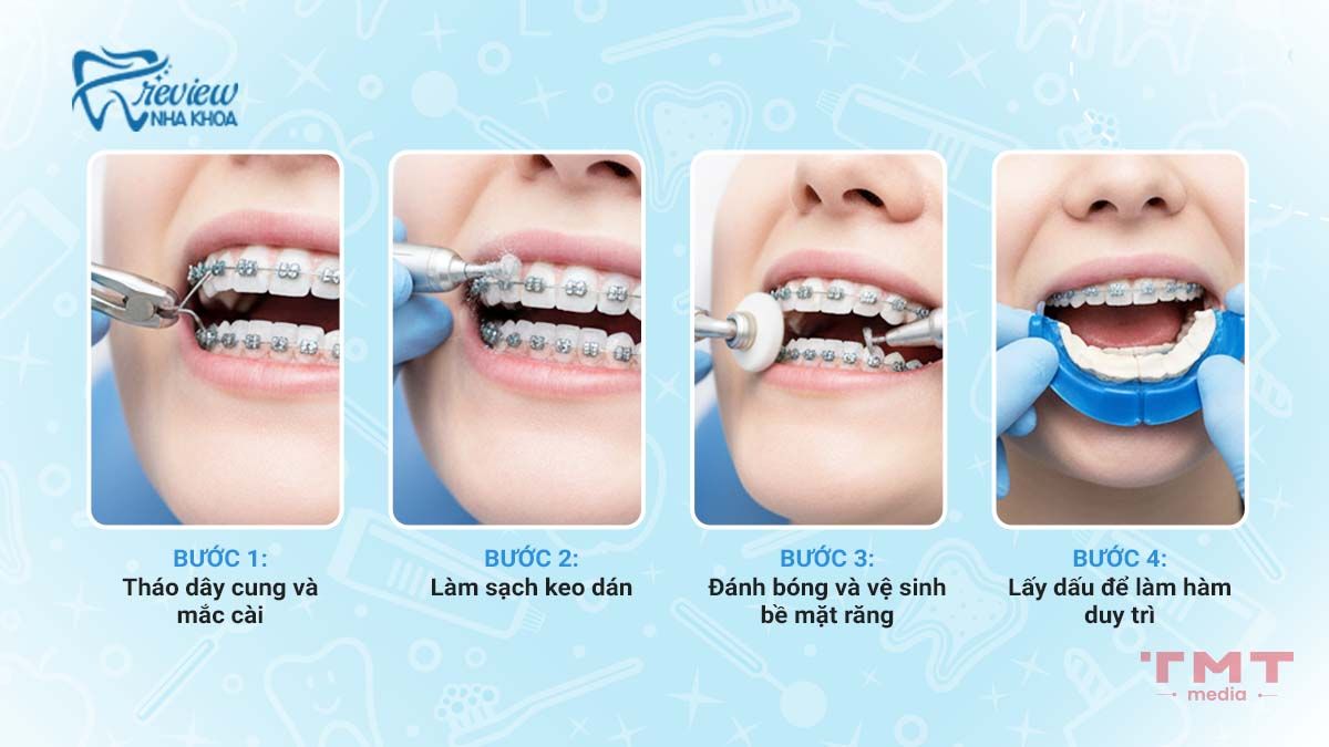 Quy trình tháo niềng răng diễn ra như thế nào tại phòng khám