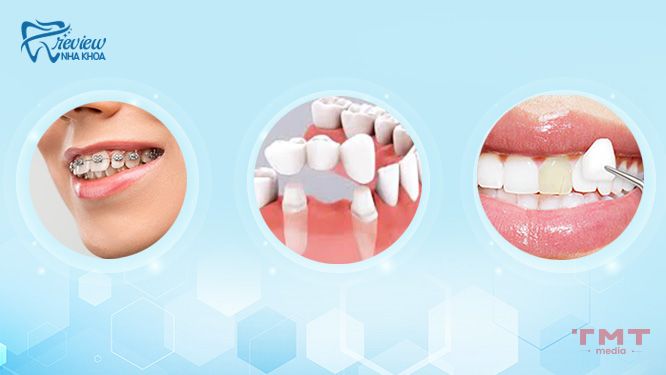 Có nên điều chỉnh răng thỏ không? Phương pháp thẩm mỹ nào an toàn?