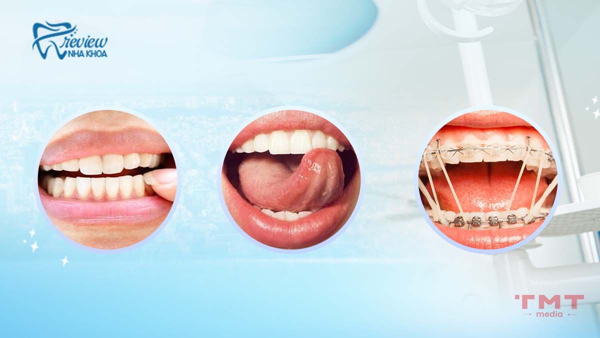 Các cách chữa răng hô tại nhà hiệu quả