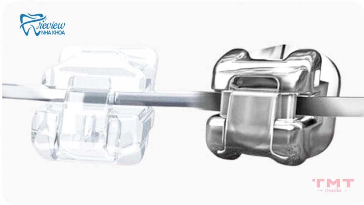 Mắc cài tự buộc là gì? Cấu tạo và nguyên lý hoạt động