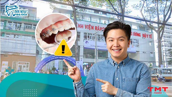 Niềng răng ở Bệnh viện Răng Hàm Mặt Trung Ương cần lưu ý những gì?