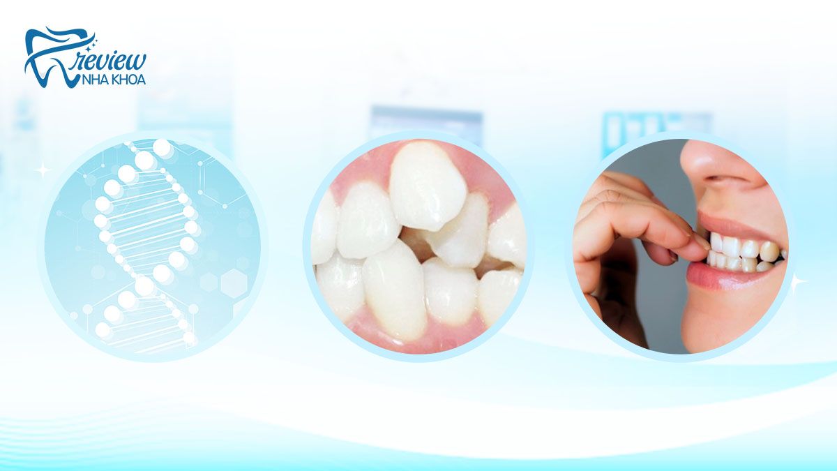 Nguyên nhân dễ đến tình trạng răng bị hô nhẹ