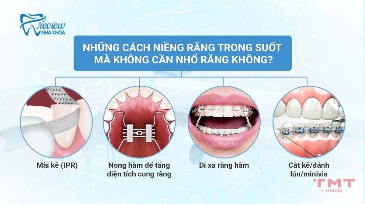 Có cách nào niềng răng trong suốt mà không cần nhổ răng không?
