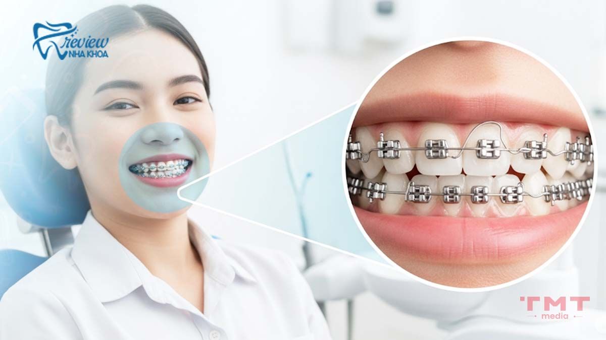 Kỹ thuật chỉnh nha không chuẩn xác làm niềng răng bị hỏi lợi