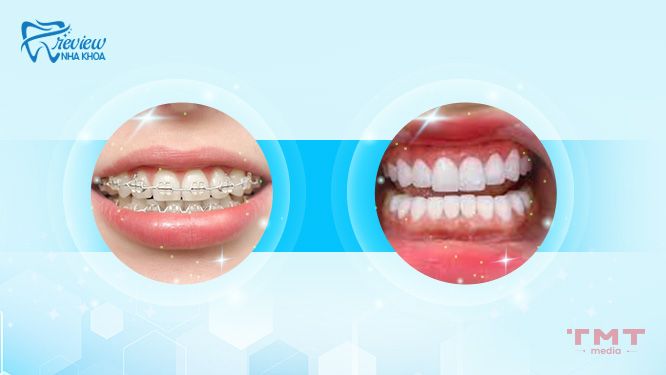 Cách khắc phục răng cửa to tại nha khoa