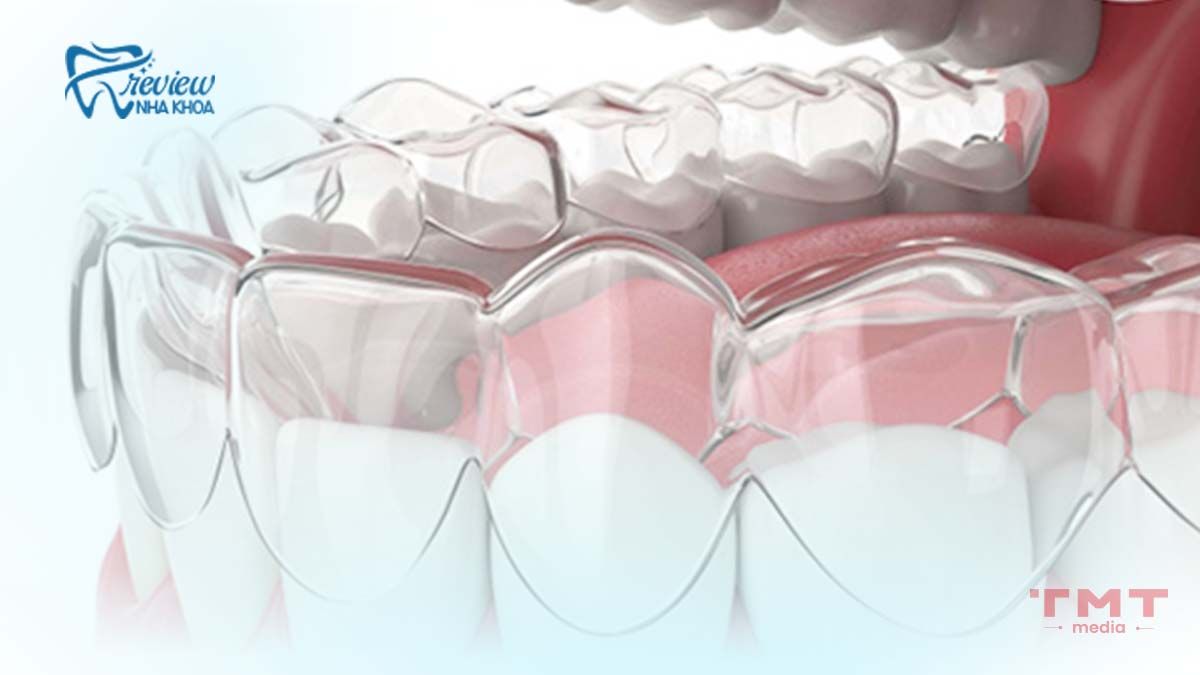 Công nghệ niềng răng trong suốt hoạt động như thế nào?
