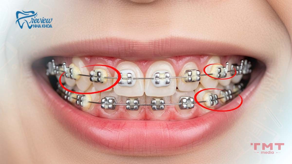 Vấn đề từ bệnh nhân làm hở lợi sau khi niềng răng