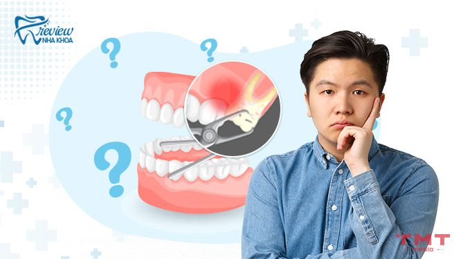câu hỏi thường gặp khi nhổ răng khôn hàm trên