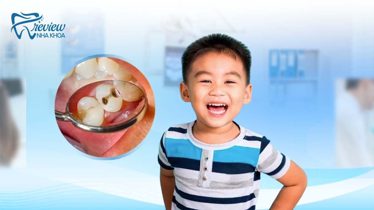Ở trẻ răng hàm có thay không?